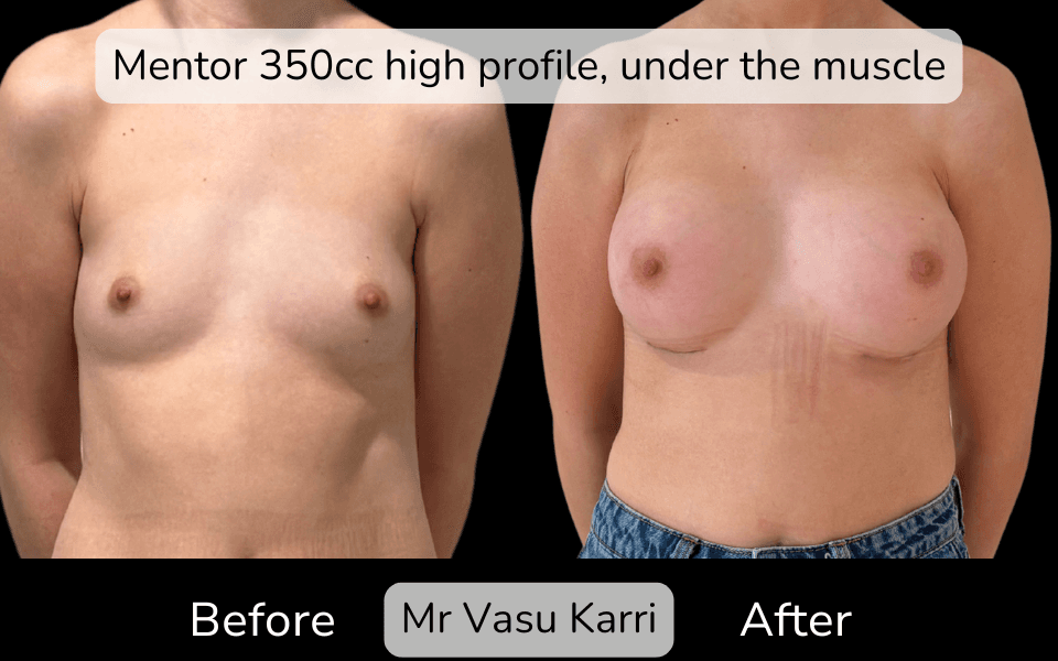 Breast Enlargement in Rotherham Before & After 1