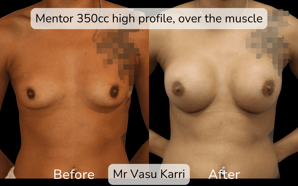 Breast Enlargement in Rotherham Before & After 2