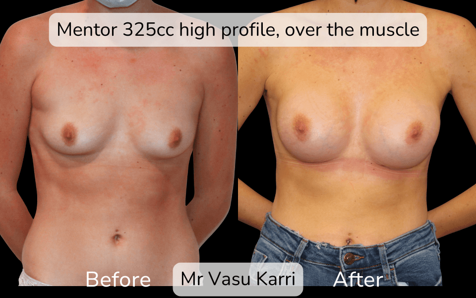 Breast Enlargement in Rotherham Before & After 3