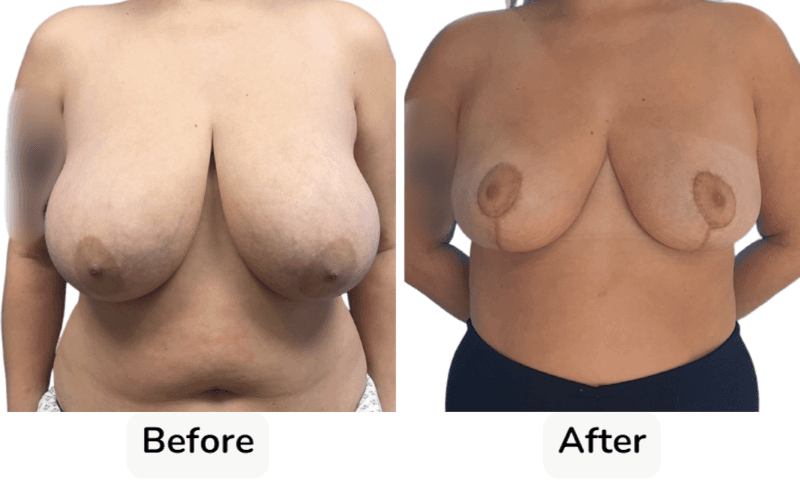 Breast Reduction Surgery in Rotherham Before & After 2