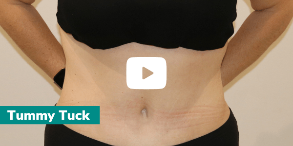 Tummy Tuck Videos